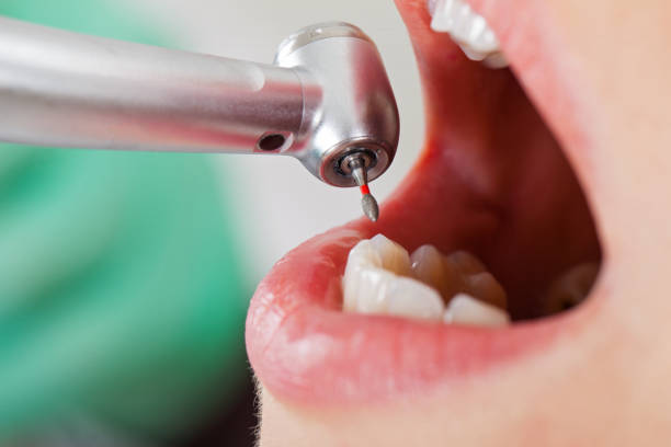Best Emergency Wisdom Teeth Removal in Dickson, OK